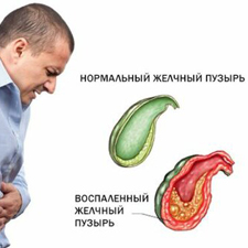 Холецистит и его лечение.