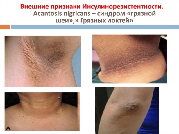 Инсулинорезистентность признаки