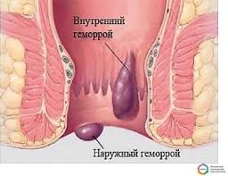 Геморрой и его лечение. Геморрой и его лечение.