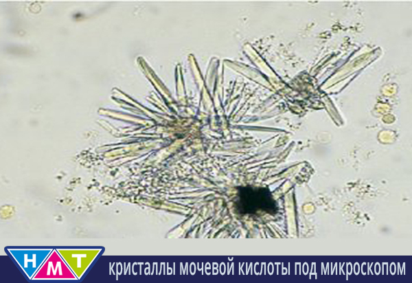 кристаллы мочевой кислоты в периферических частях тела