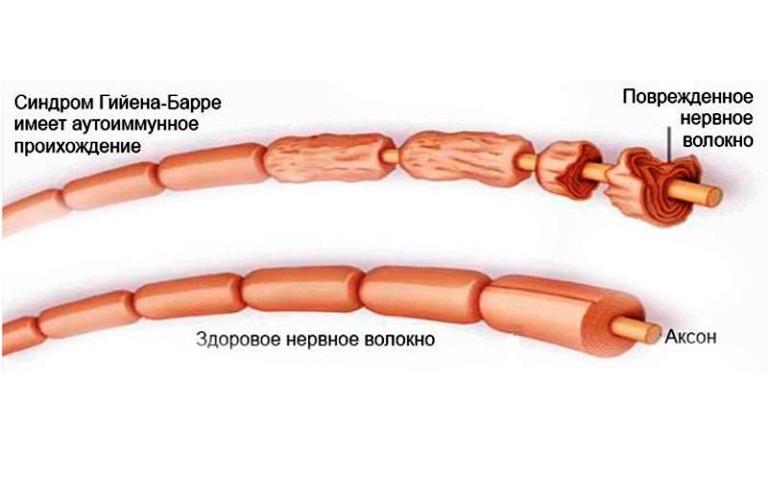 Синдром Гийена Баре