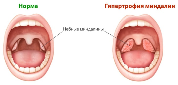 Удаление миндалин - тонзиллэктомия коблатором Удаление миндалин - тонзиллэктомия