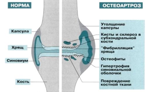 Изменения при остеоартрозе